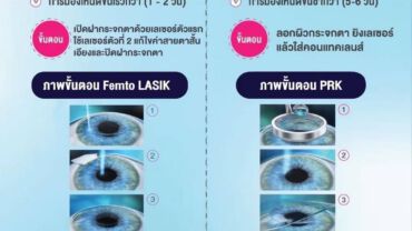 Femto Lasik PRK