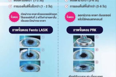Femto Lasik PRK