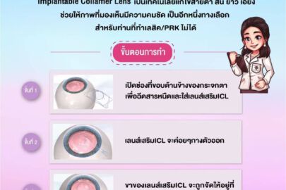 การทำ ICL