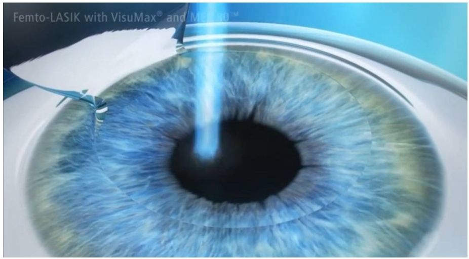 EXCIMER LASER ใช้เลเซอร์แก้ไขค่าสายตาสั้น เอีย