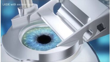 SBK LASIK (เลสิควงแหวน SBK)